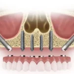 zygomatic dental implant for teeth