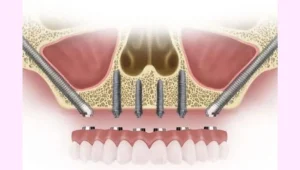 zygomatic dental implant for teeth