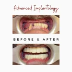 Advanced Implantology | Dental Implants