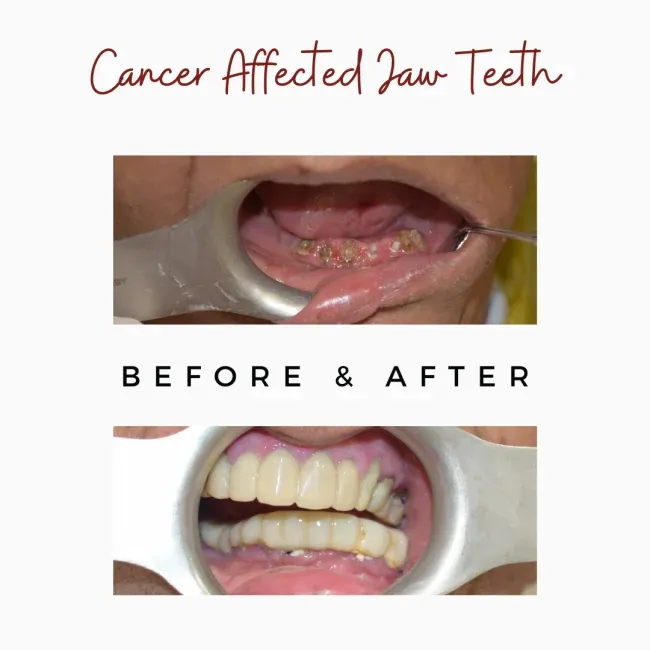 Cancer Affected Jaw Teeth