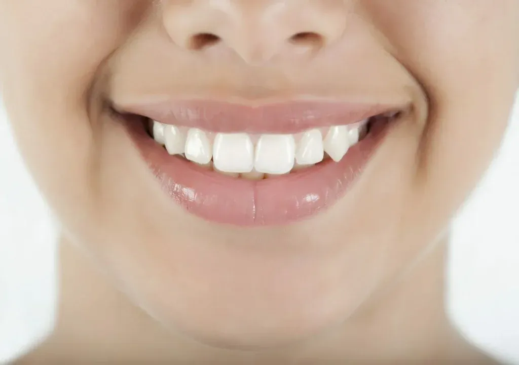 crooked teeth smile makeover