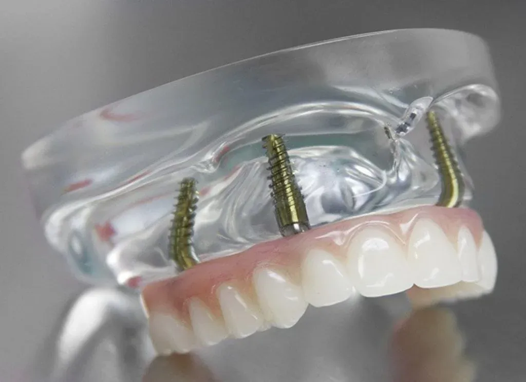 Graftless Solution For Permanent Teeth