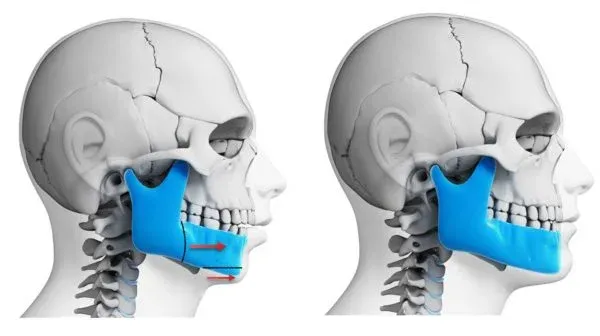 Upper Jaw Orthognathic Surgery