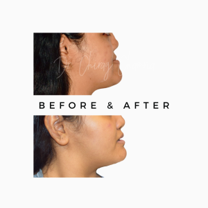 Orthognathic Jaw Surgery