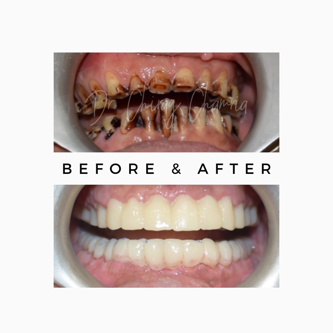 Teteh Stains Removal in Mumbai