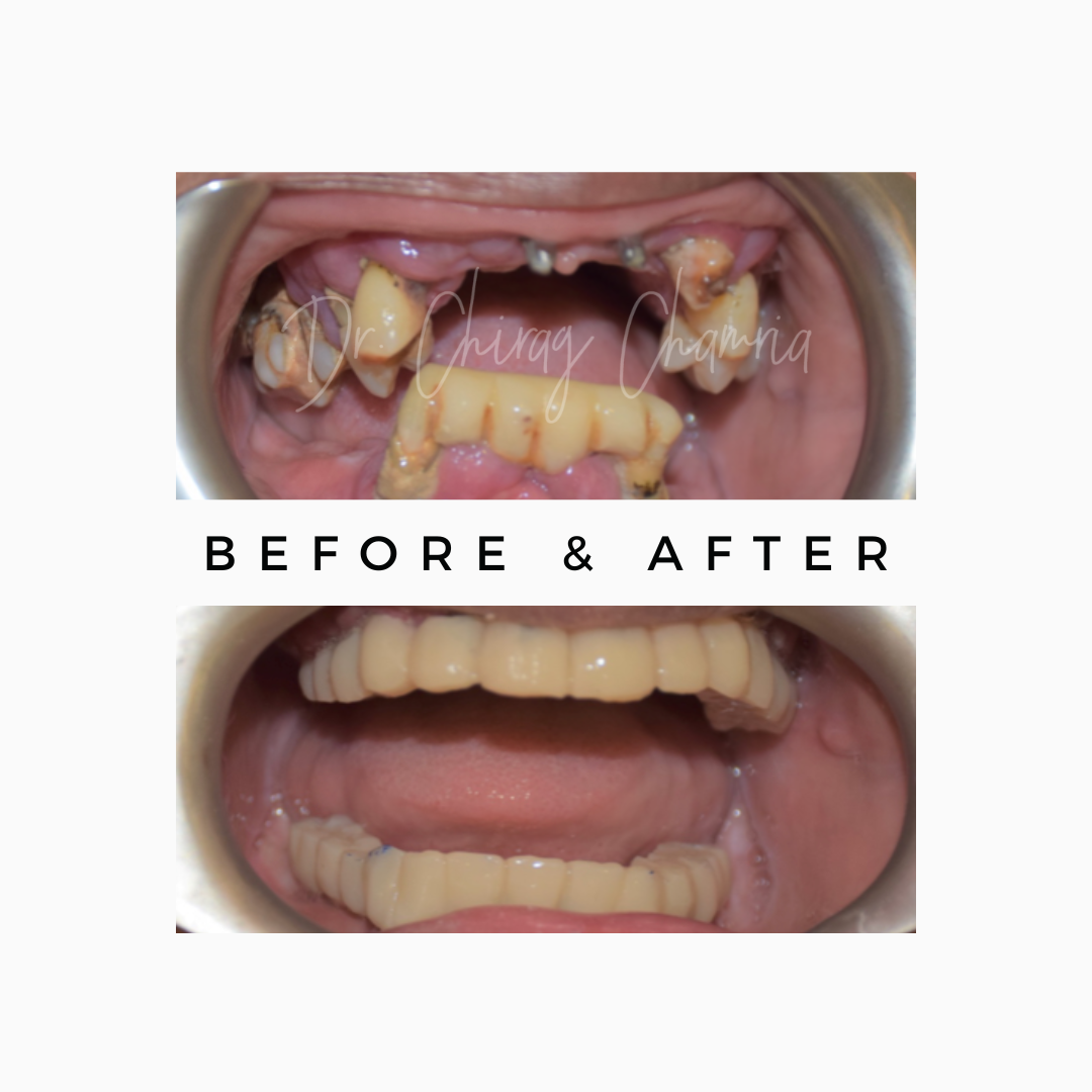 Missing teeth in Mumbai