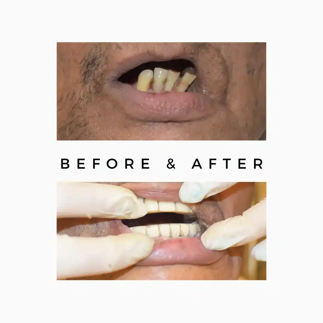 Full Mouth Teeth implants