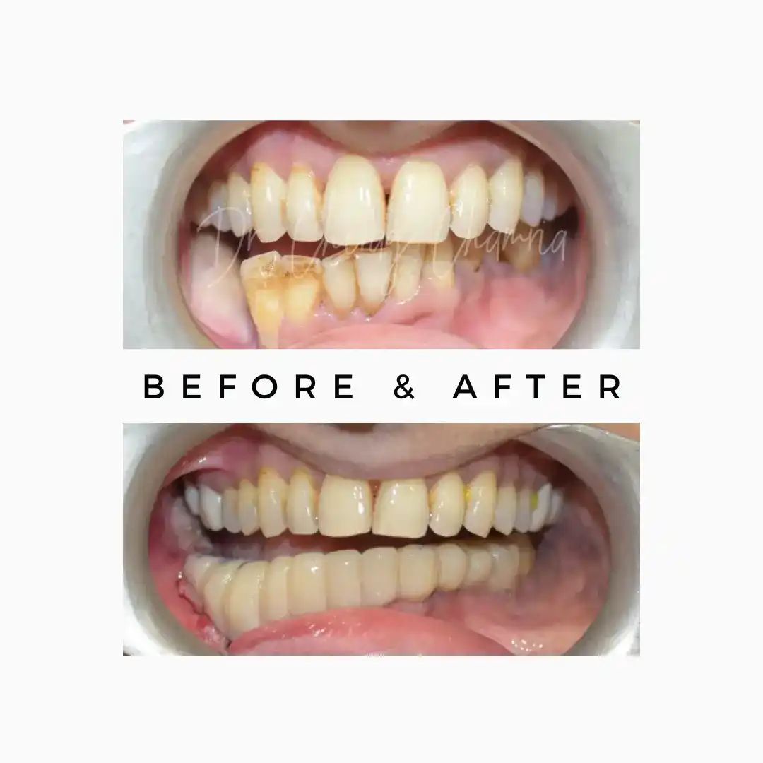 Cancer Rehabilitation of Teeth