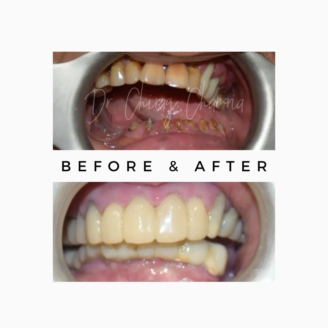 Before After Dental Treatment