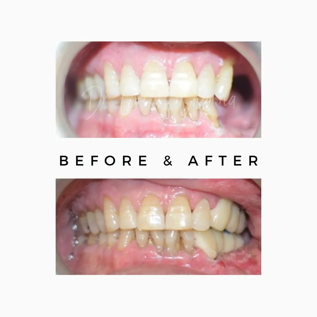 Fixed Teeth with Implant